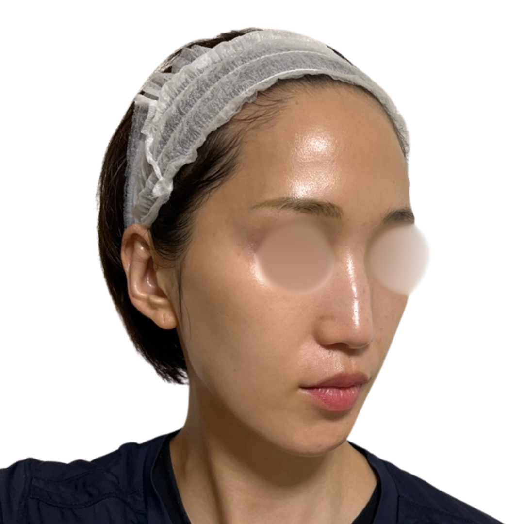 ピコフォーカス（ピコトーニング＋ピコフラクショナル）